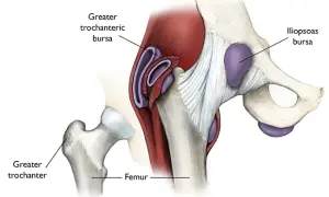 Causas y tratamientos del dolor en los músculos de la cadera
