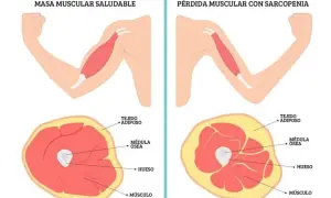 Cómo prevenir la pérdida de masa muscular y mejorar tu calidad de vida