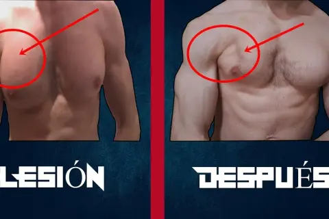 Desgarro muscular en el pecho: síntomas, causas y tratamientos efectivos