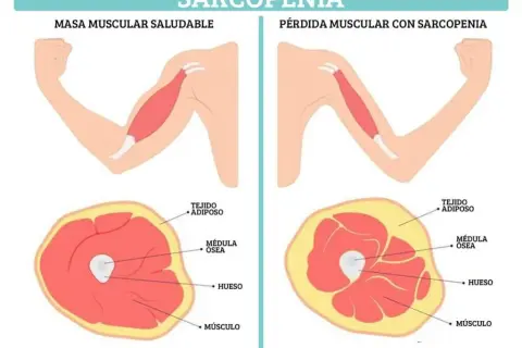 Cómo prevenir la pérdida de masa muscular y mejorar tu calidad de vida