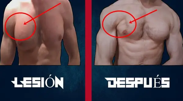 Desgarro muscular en el pecho: síntomas, causas y tratamientos efectivos